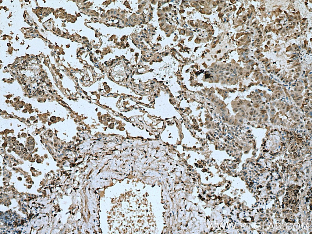 Immunohistochemistry (IHC) staining of human lung cancer tissue using METTL6 Polyclonal antibody (16527-1-AP)