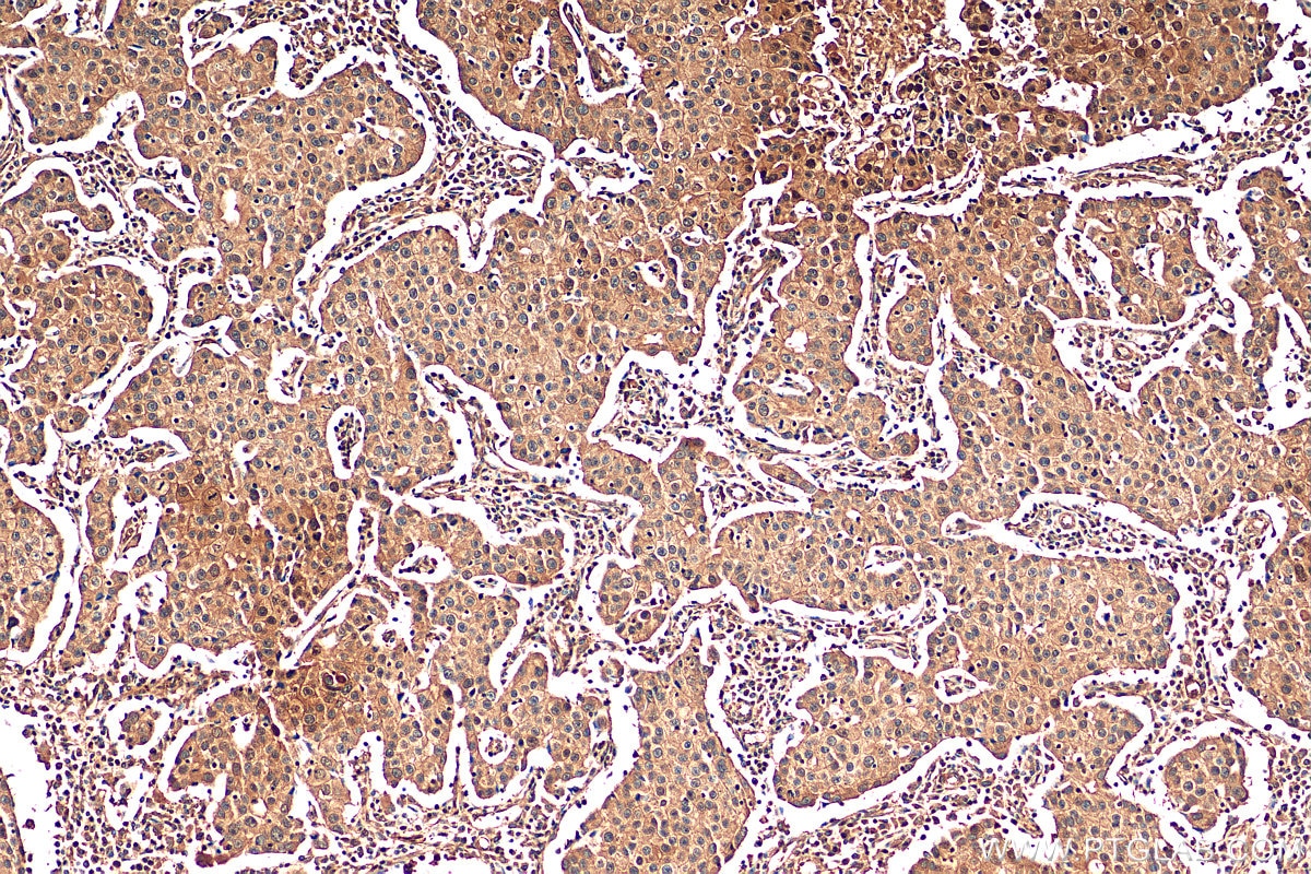 Immunohistochemistry (IHC) staining of human breast cancer tissue using METTL6 Monoclonal antibody (68400-1-Ig)