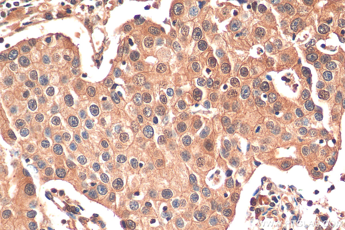Immunohistochemistry (IHC) staining of human breast cancer tissue using METTL6 Monoclonal antibody (68400-1-Ig)