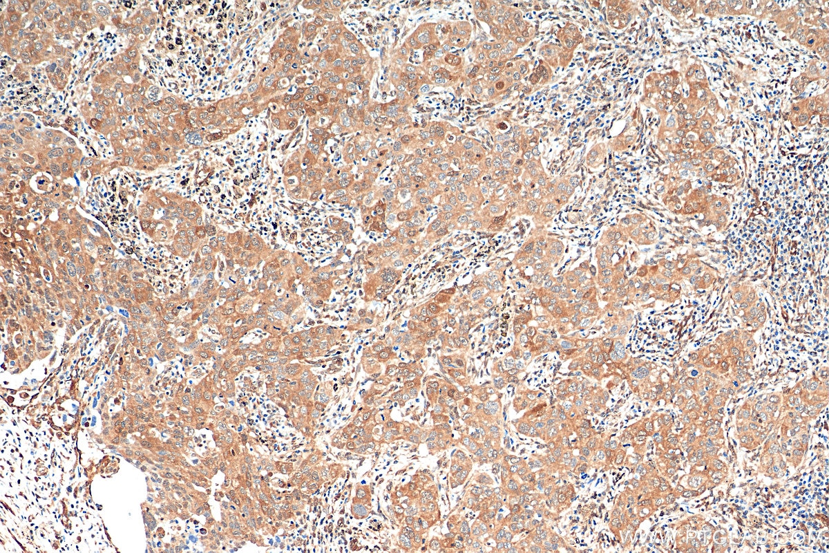 Immunohistochemistry (IHC) staining of human lung cancer tissue using METTL6 Monoclonal antibody (68400-1-Ig)
