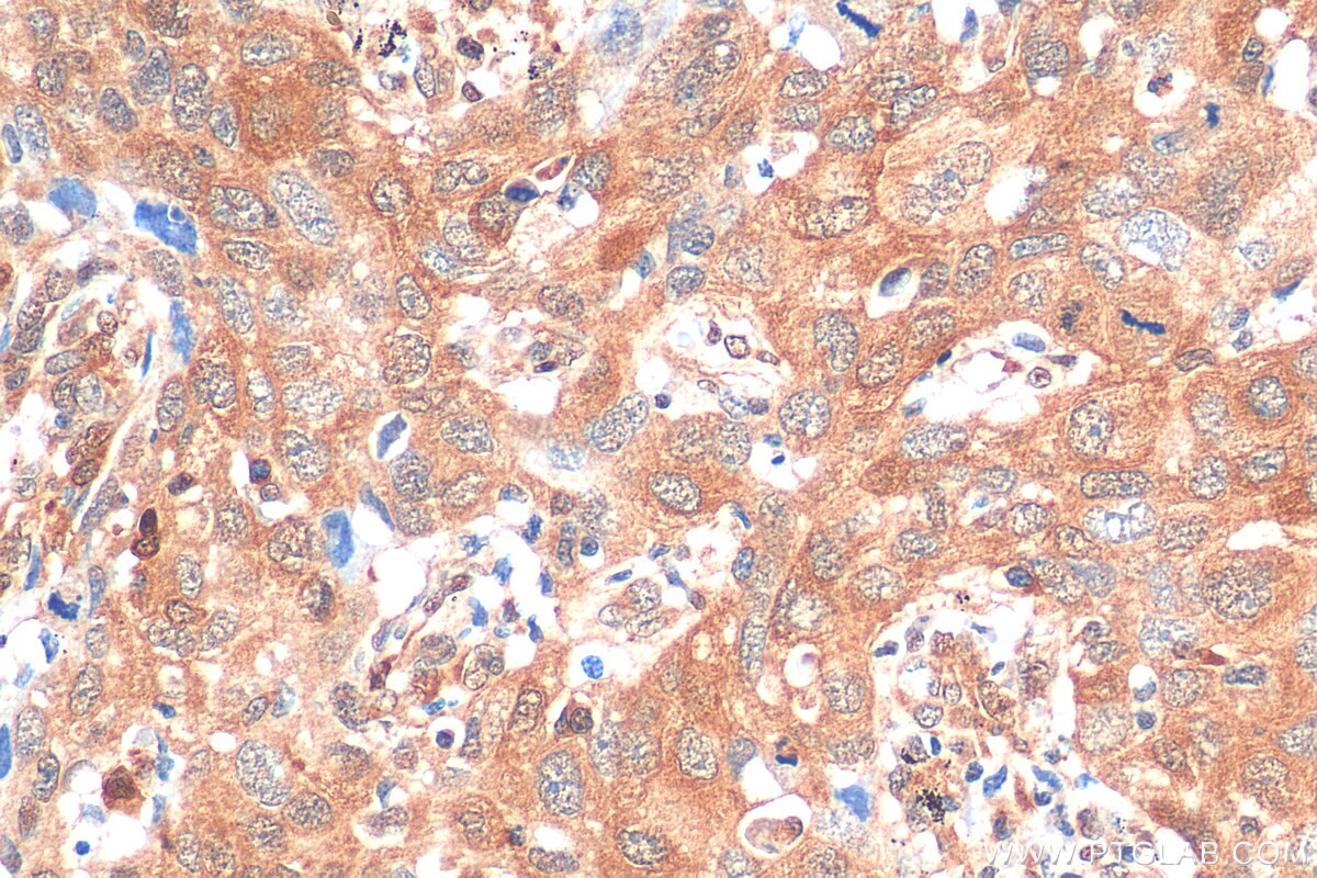 Immunohistochemistry (IHC) staining of human lung cancer tissue using METTL6 Monoclonal antibody (68400-1-Ig)