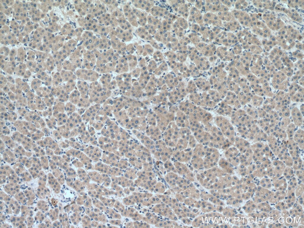 Immunohistochemistry (IHC) staining of human liver cancer tissue using METTL7A Polyclonal antibody (17092-1-AP)