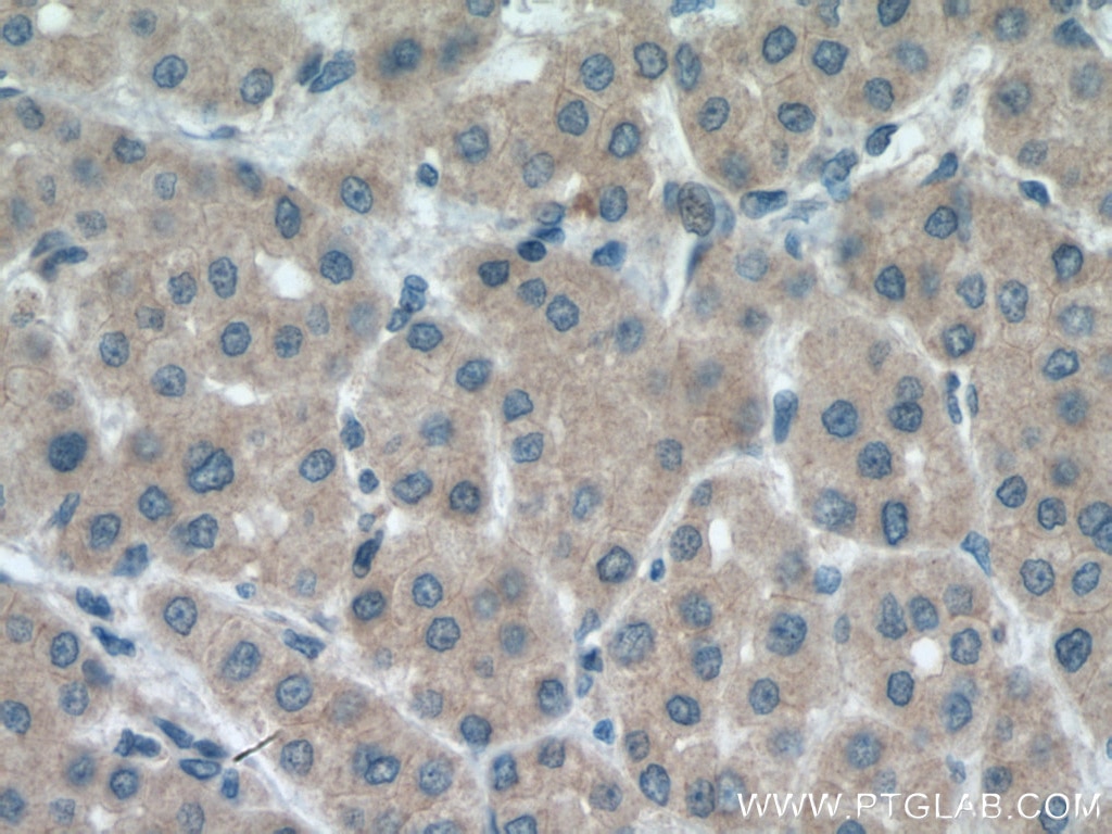 Immunohistochemistry (IHC) staining of human liver cancer tissue using METTL7A Polyclonal antibody (17092-1-AP)