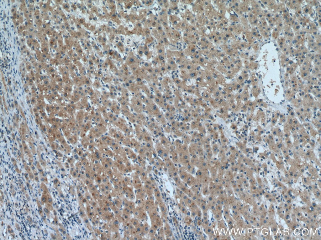 Immunohistochemistry (IHC) staining of human liver cancer tissue using METTL7A Polyclonal antibody (17092-1-AP)