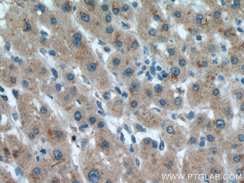 Immunohistochemistry (IHC) staining of human liver cancer tissue using METTL7A Polyclonal antibody (17092-1-AP)