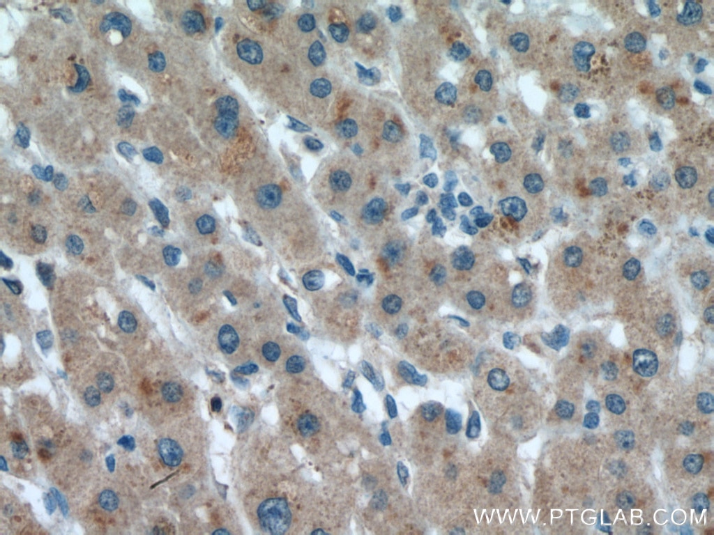 IHC staining of human liver cancer using 17092-1-AP