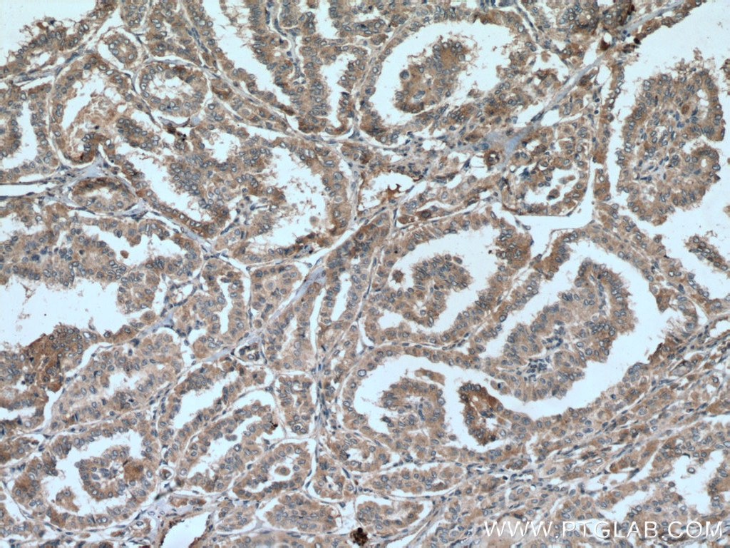 Immunohistochemistry (IHC) staining of human thyroid cancer tissue using METTL7A Polyclonal antibody (17092-1-AP)