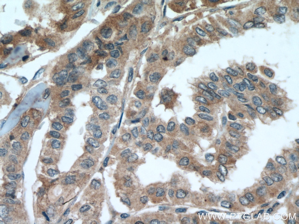 Immunohistochemistry (IHC) staining of human thyroid cancer tissue using METTL7A Polyclonal antibody (17092-1-AP)