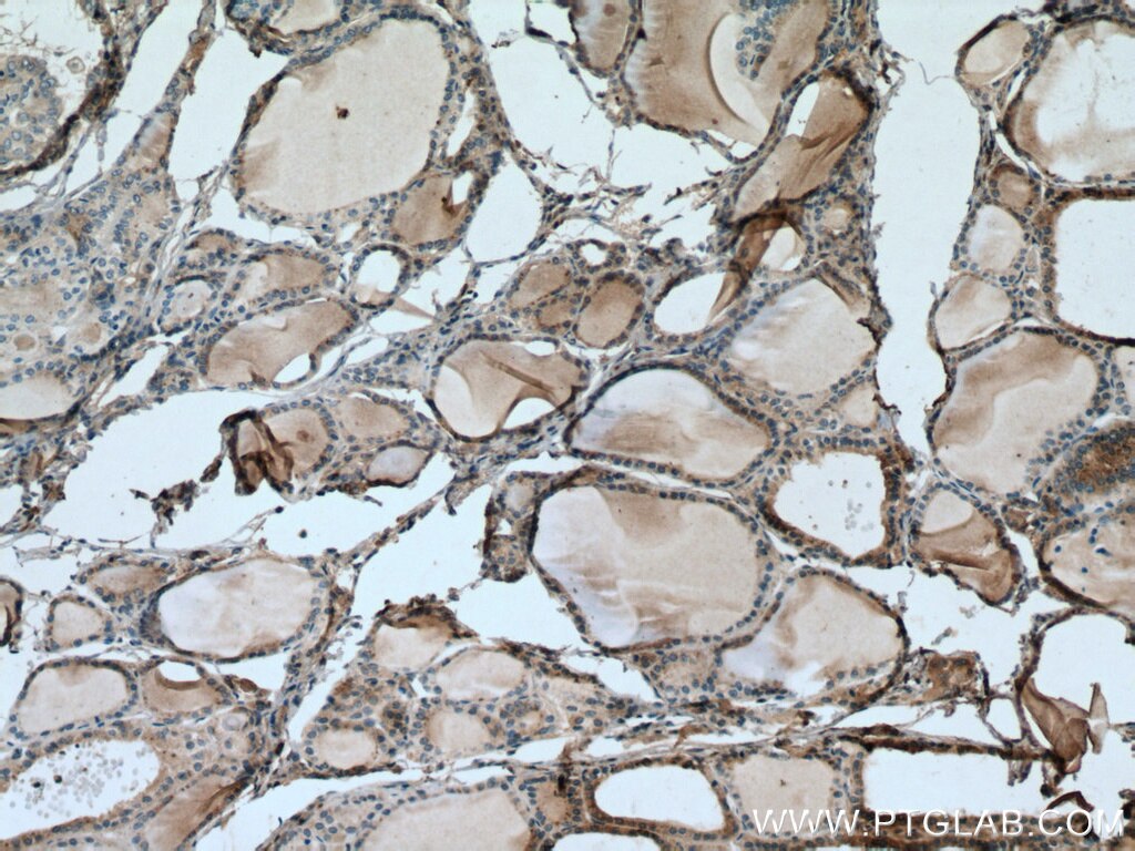 Immunohistochemistry (IHC) staining of human thyroid cancer tissue using METTL7A Polyclonal antibody (17092-1-AP)