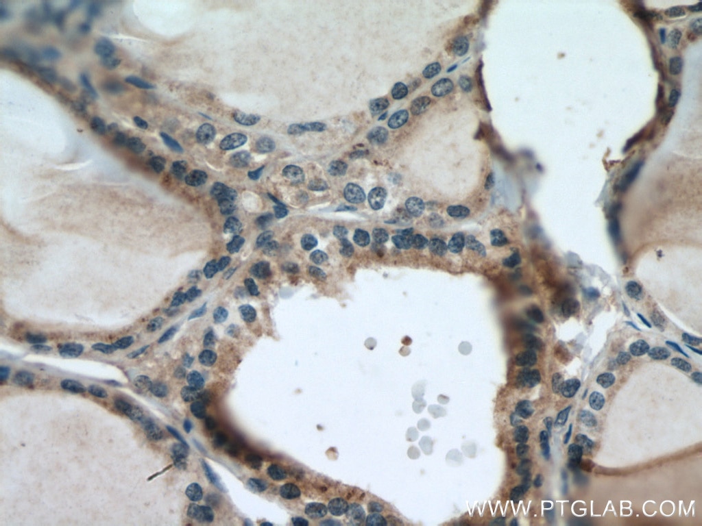 Immunohistochemistry (IHC) staining of human thyroid cancer tissue using METTL7A Polyclonal antibody (17092-1-AP)