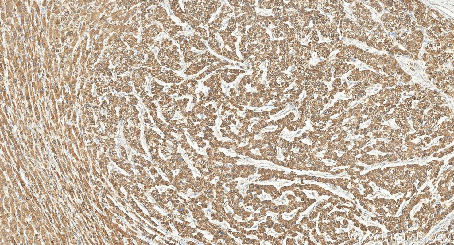 Immunohistochemistry (IHC) staining of human liver cancer tissue using METTL7A Polyclonal antibody (17092-1-AP)