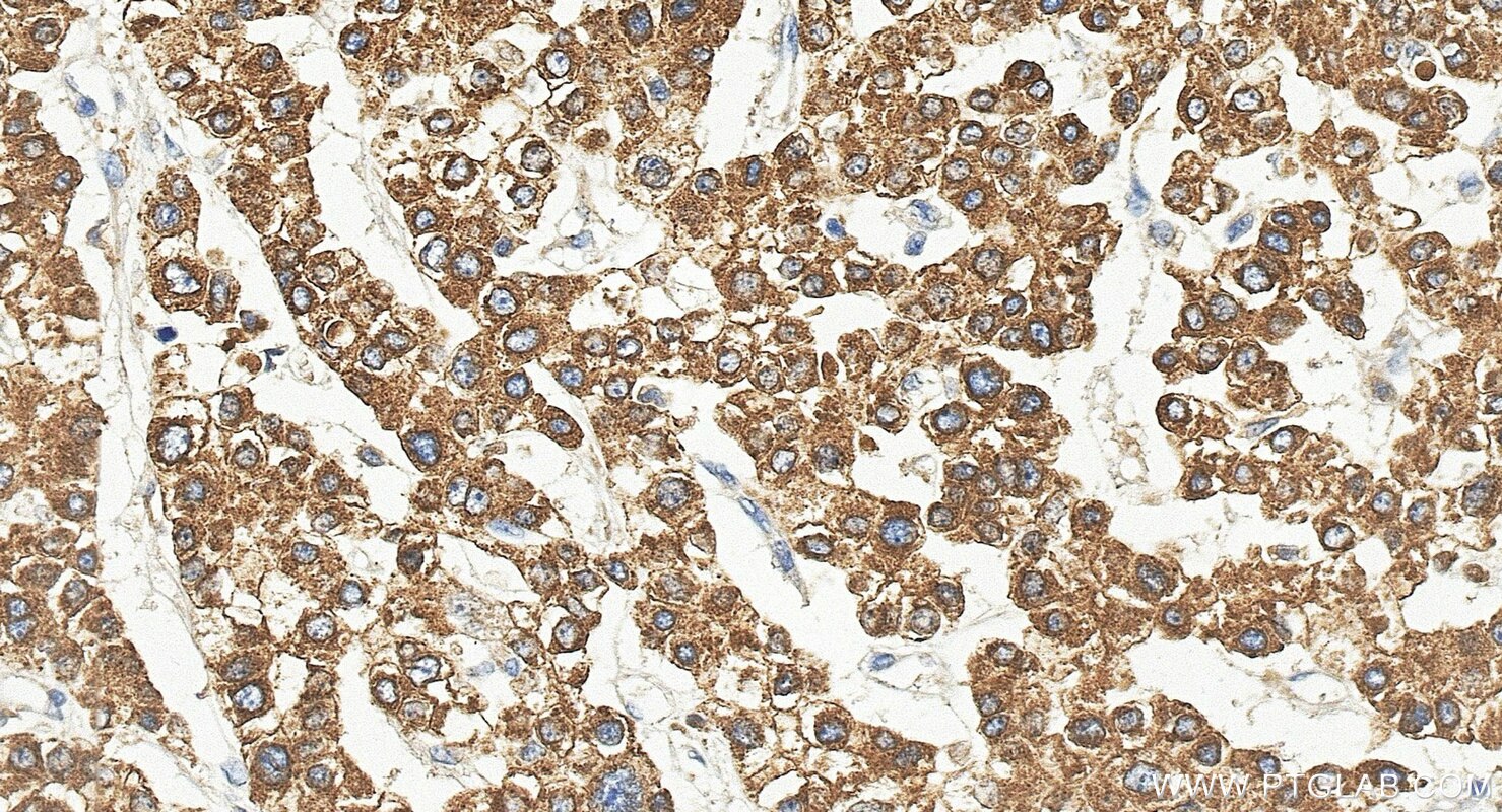 Immunohistochemistry (IHC) staining of human liver cancer tissue using METTL7A Polyclonal antibody (17092-1-AP)