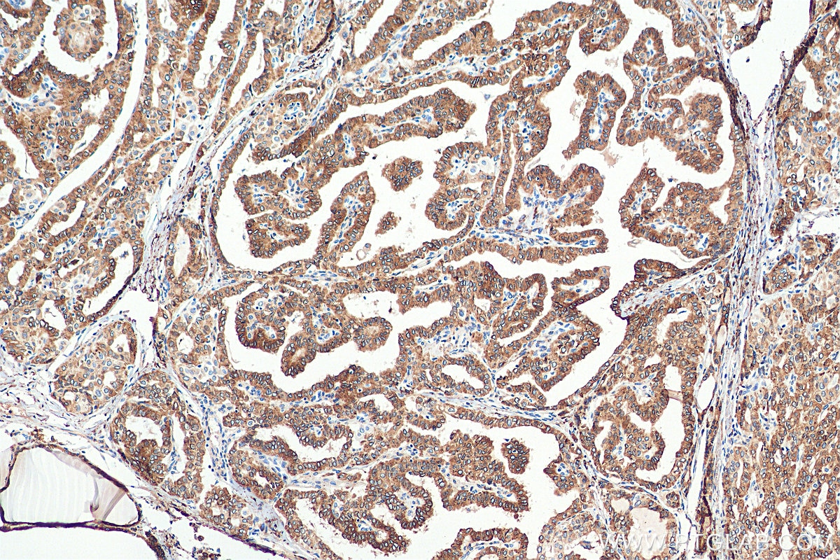 Immunohistochemistry (IHC) staining of human thyroid cancer tissue using METTL7A Monoclonal antibody (67905-1-Ig)