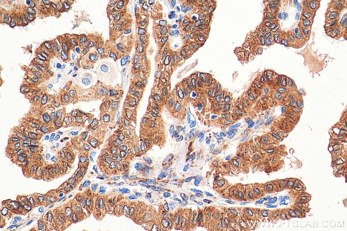 Immunohistochemistry (IHC) staining of human thyroid cancer tissue using METTL7A Monoclonal antibody (67905-1-Ig)