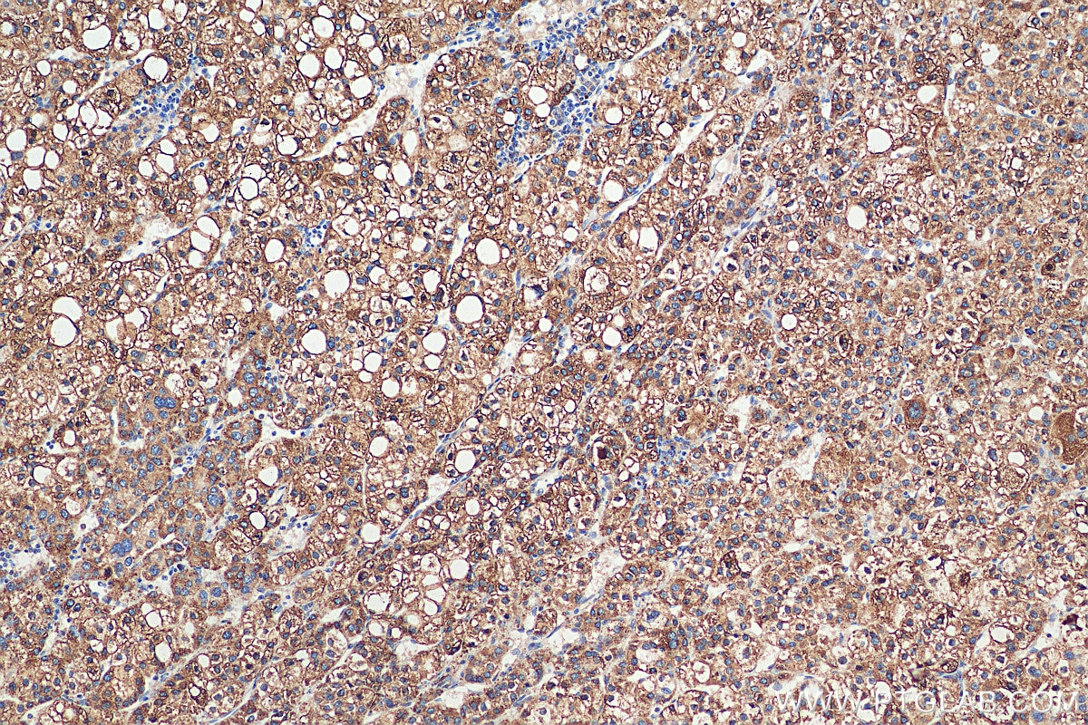 Immunohistochemistry (IHC) staining of human liver cancer tissue using METTL7A Monoclonal antibody (67905-1-Ig)