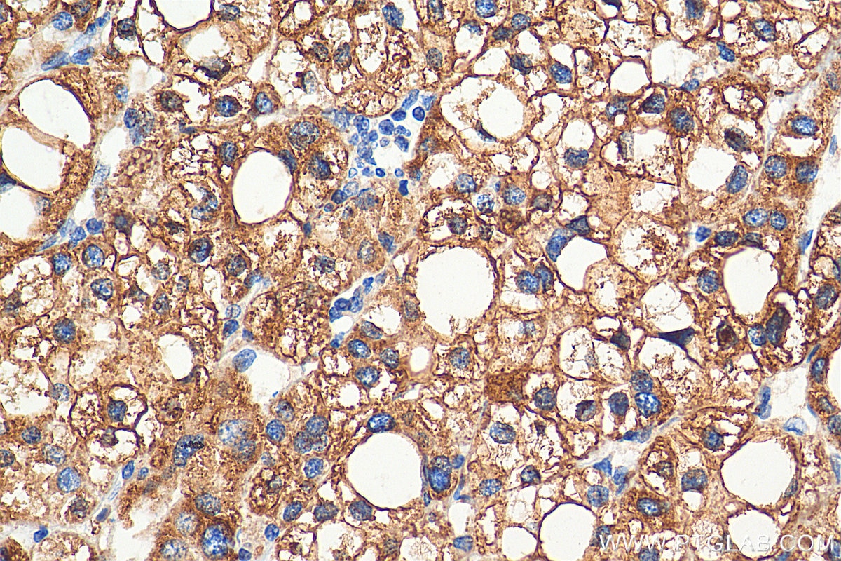 Immunohistochemistry (IHC) staining of human liver cancer tissue using METTL7A Monoclonal antibody (67905-1-Ig)