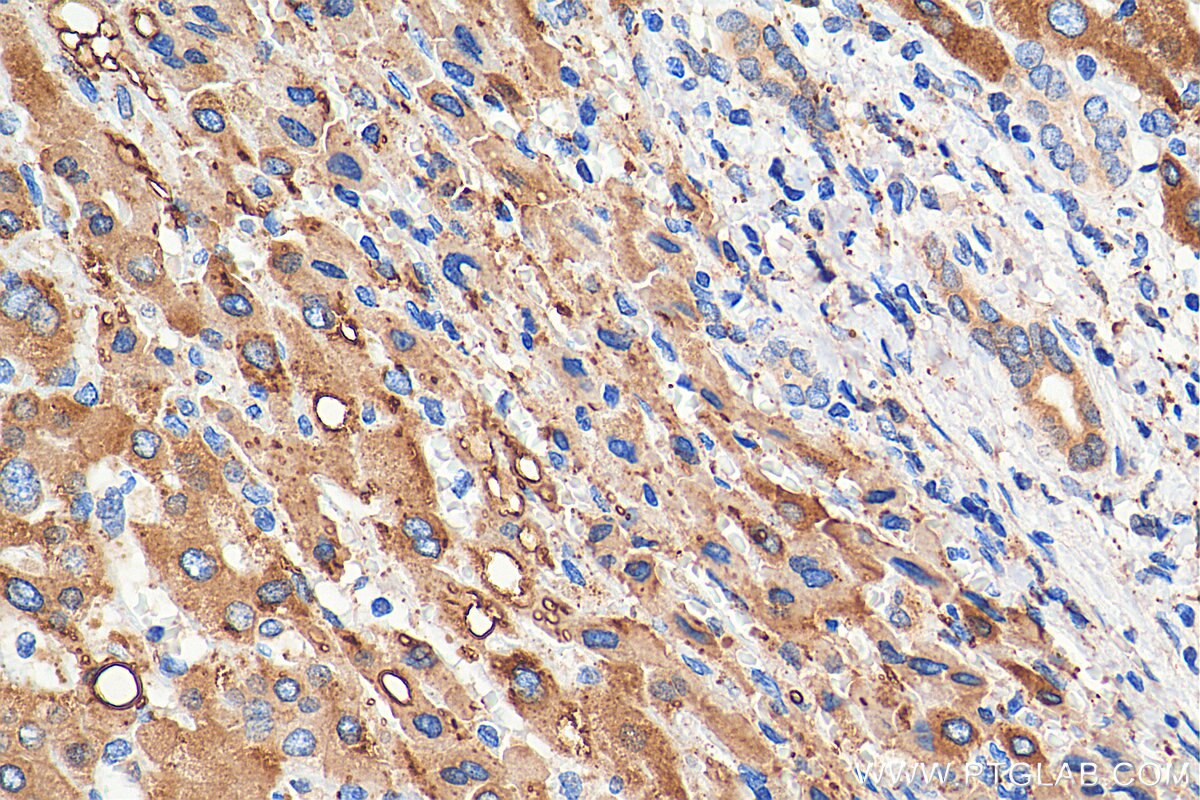 Immunohistochemistry (IHC) staining of human liver cancer tissue using METTL7A Monoclonal antibody (67905-1-Ig)