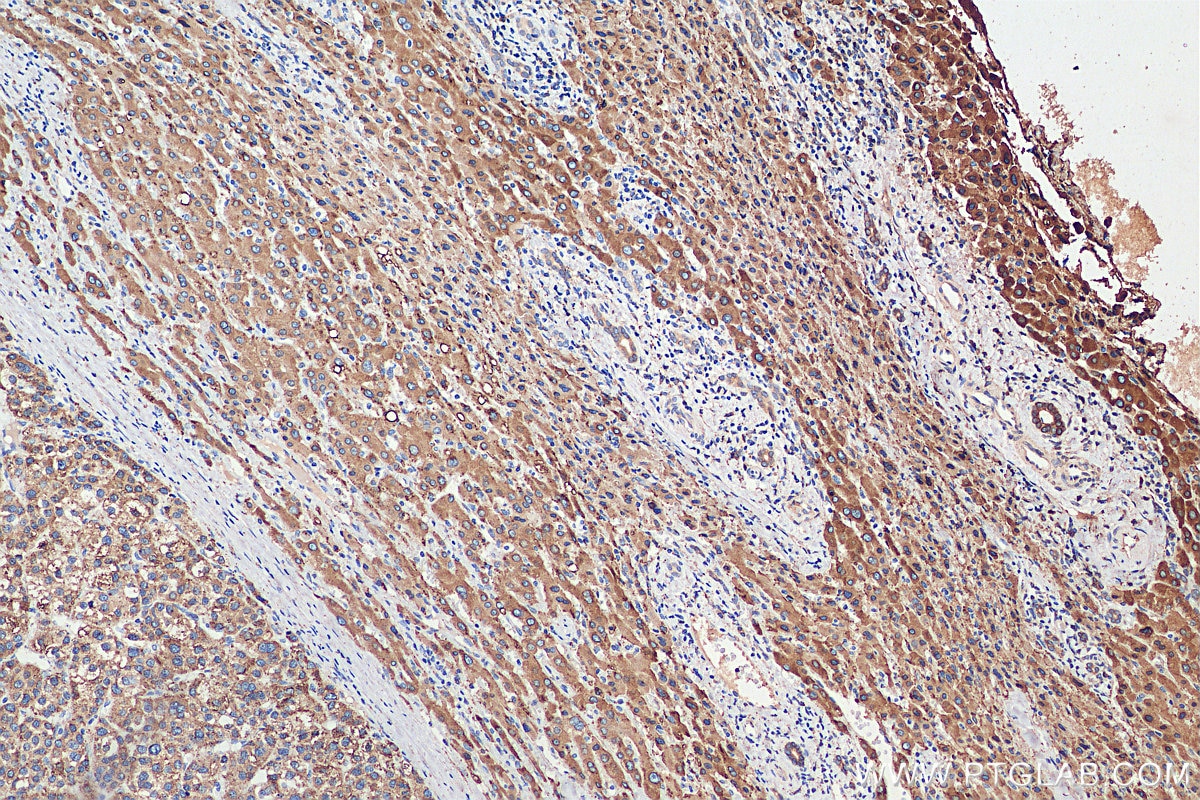 Immunohistochemistry (IHC) staining of human liver cancer tissue using METTL7A Monoclonal antibody (67905-1-Ig)