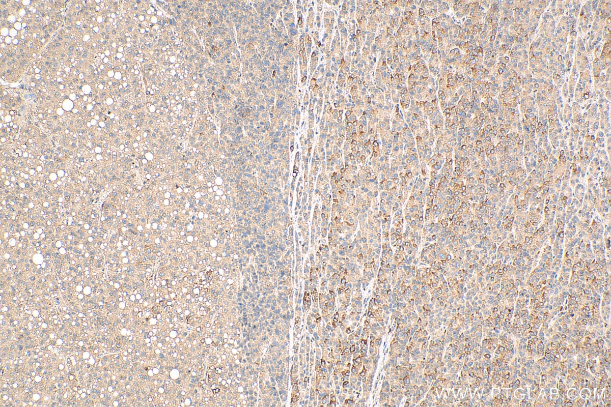 IHC staining of human liver cancer using 15120-1-AP