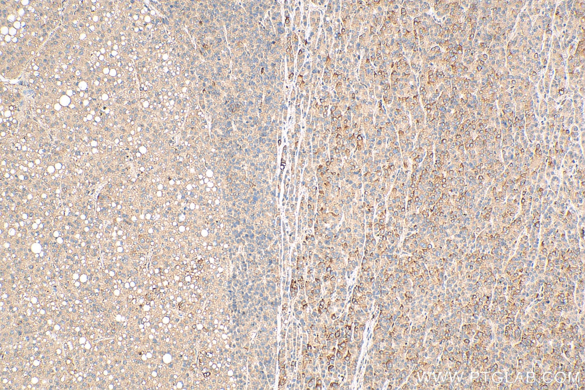 Immunohistochemistry (IHC) staining of human liver cancer tissue using METTL9 Polyclonal antibody (15120-1-AP)