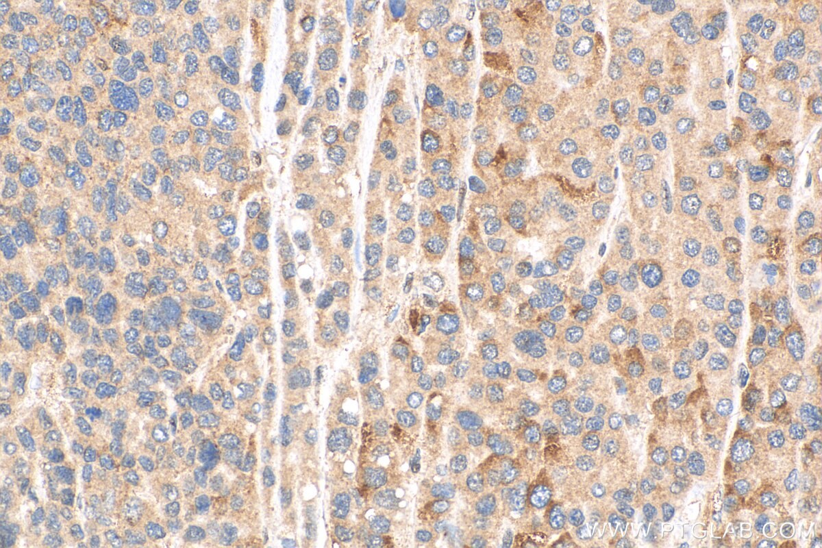 Immunohistochemistry (IHC) staining of human liver cancer tissue using METTL9 Polyclonal antibody (15120-1-AP)