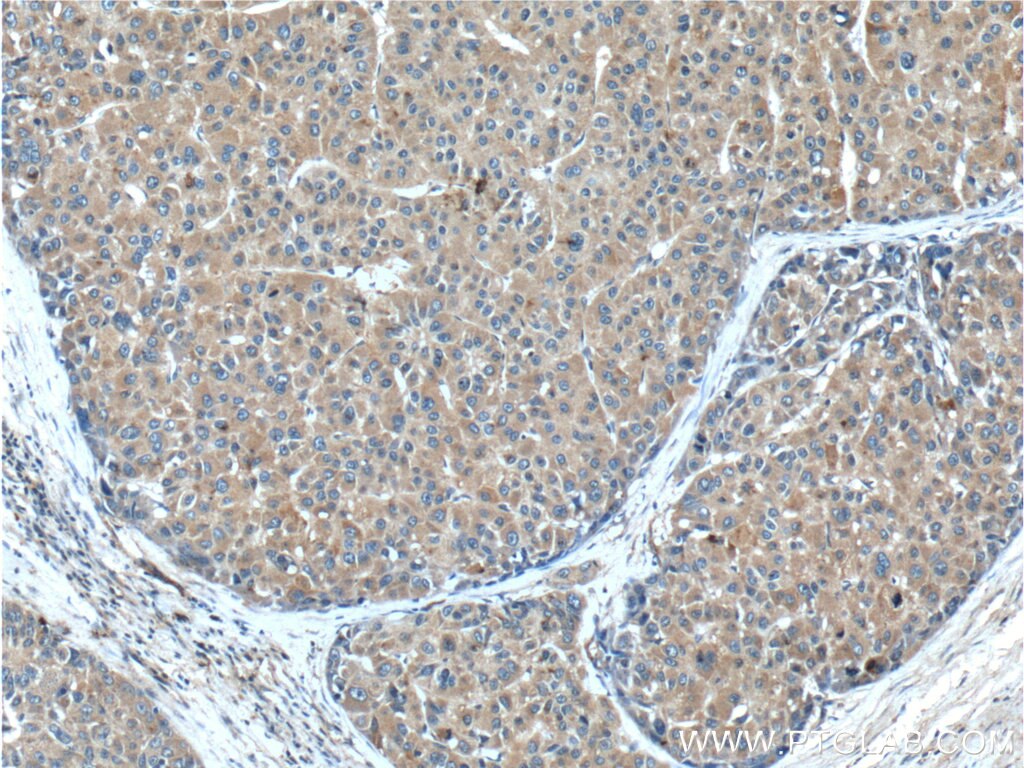 Immunohistochemistry (IHC) staining of human liver cancer tissue using METTL9 Polyclonal antibody (15120-1-AP)