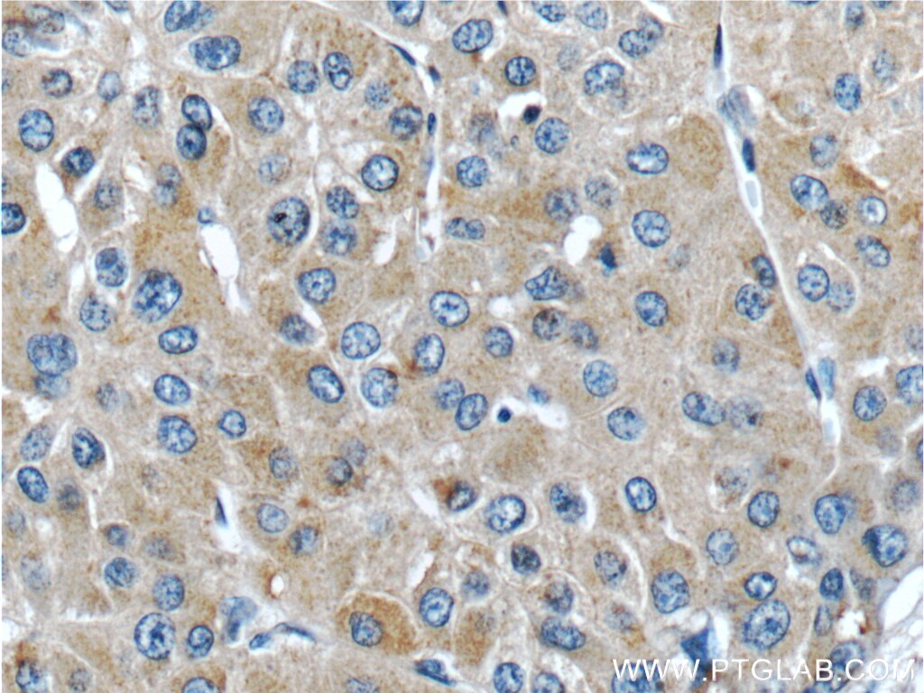 Immunohistochemistry (IHC) staining of human liver cancer tissue using METTL9 Polyclonal antibody (15120-1-AP)
