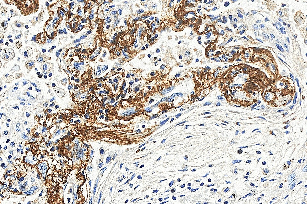IHC staining of human lung using 88535-1-RR (same clone as 88535-1-PBS) Immunohistochemistry (IHC) staining of human lung tissue using MFAP4 Recombinant monoclonal antibody (88535-1-RR)