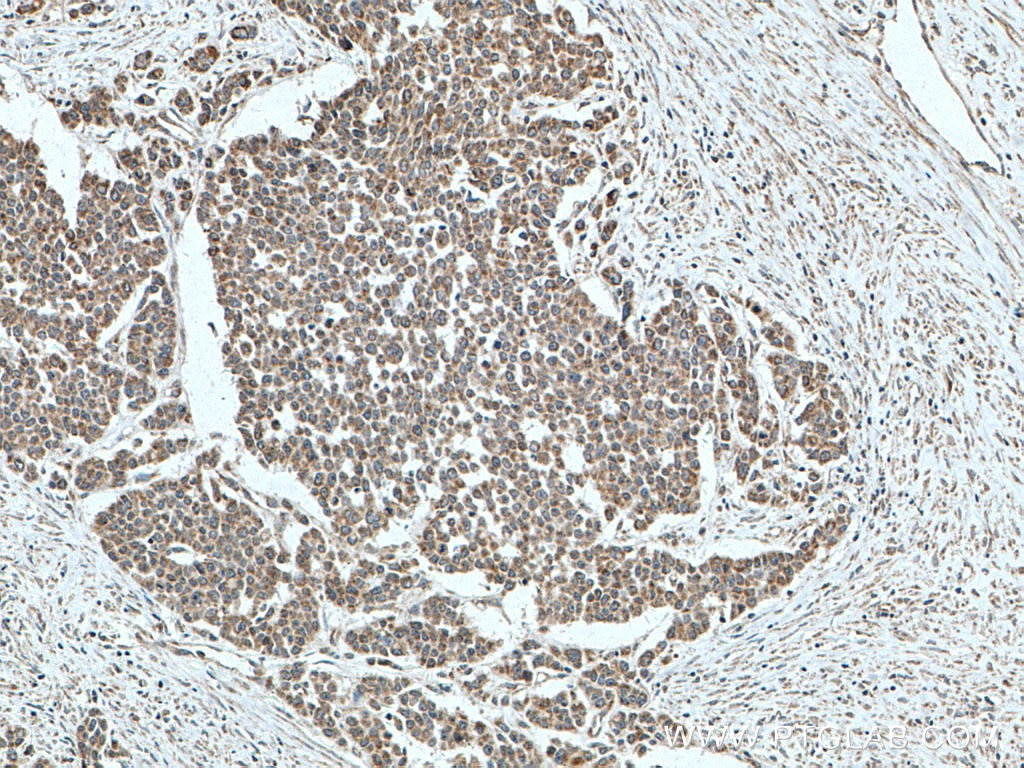 Immunohistochemistry (IHC) staining of human colon cancer tissue using MFN1 Monoclonal antibody (66776-1-Ig)