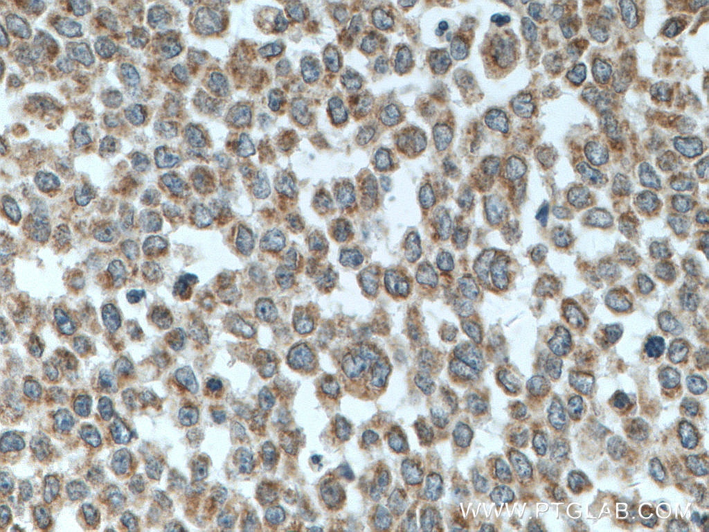 Immunohistochemistry (IHC) staining of human colon cancer tissue using MFN1 Monoclonal antibody (66776-1-Ig)