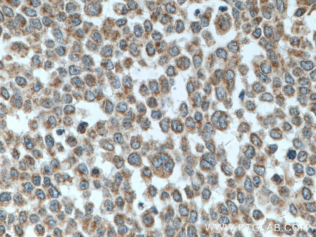 IHC staining of human colon cancer using 66776-1-Ig