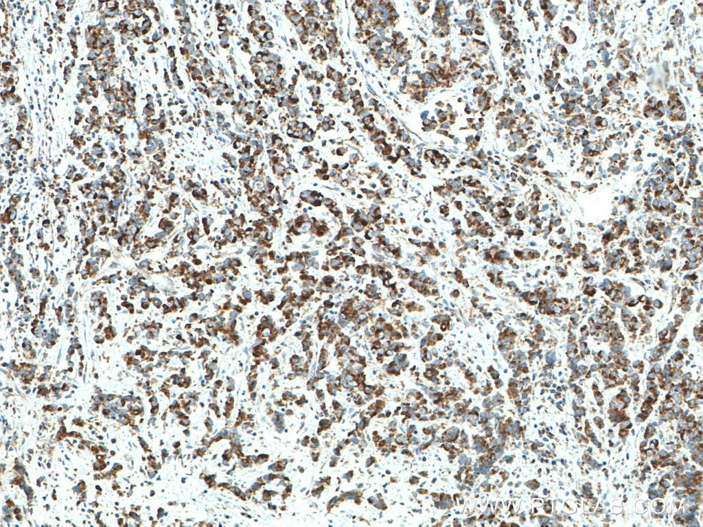 Immunohistochemistry (IHC) staining of human prostate cancer tissue using MFN1 Monoclonal antibody (66776-1-Ig)