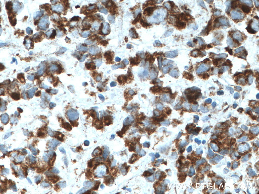 Immunohistochemistry (IHC) staining of human prostate cancer tissue using MFN1 Monoclonal antibody (66776-1-Ig)