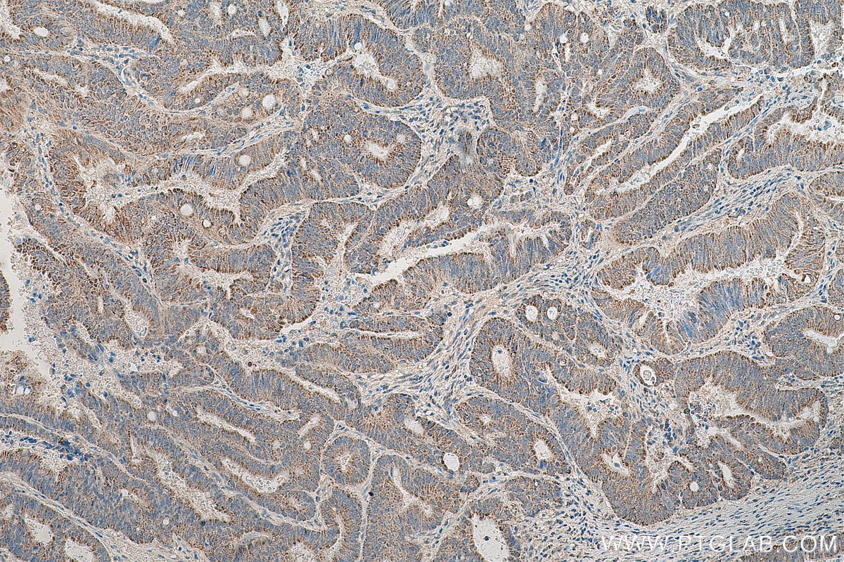 Immunohistochemistry (IHC) staining of human colon cancer tissue using MFN2 Polyclonal antibody (12186-1-AP)