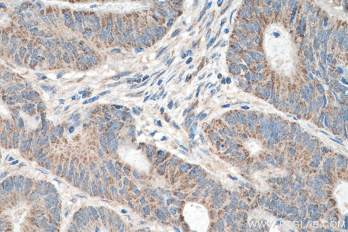 Immunohistochemistry (IHC) staining of human colon cancer tissue using MFN2 Polyclonal antibody (12186-1-AP)