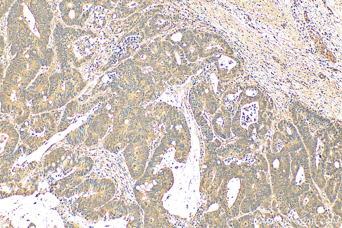Immunohistochemistry (IHC) staining of human colon cancer tissue using MFN2 Recombinant antibody (82673-2-RR)