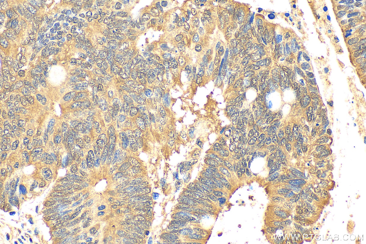 Immunohistochemistry (IHC) staining of human colon cancer tissue using MFN2 Recombinant antibody (82673-2-RR)