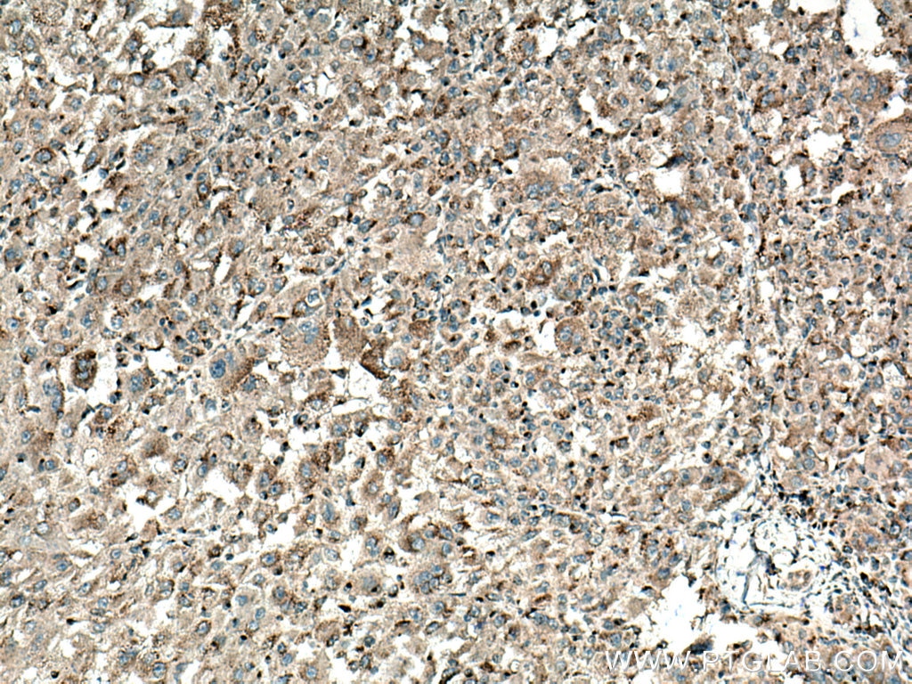 Immunohistochemistry (IHC) staining of human liver cancer tissue using MGAT1 Polyclonal antibody (15103-1-AP)