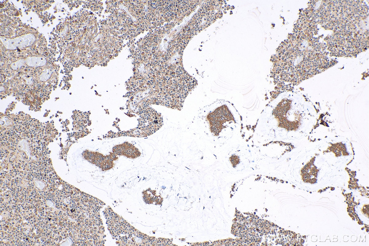 Immunohistochemistry (IHC) staining of human colon cancer tissue using MGAT3 Polyclonal antibody (17869-1-AP)