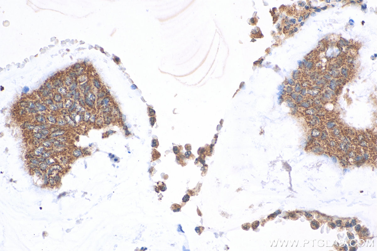 Immunohistochemistry (IHC) staining of human colon cancer tissue using MGAT3 Polyclonal antibody (17869-1-AP)
