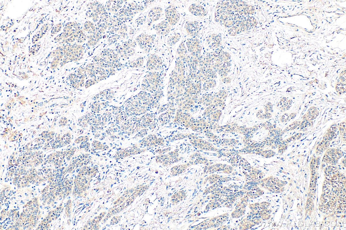 Immunohistochemistry (IHC) staining of human breast cancer tissue using MGAT4A Polyclonal antibody (25109-1-AP)