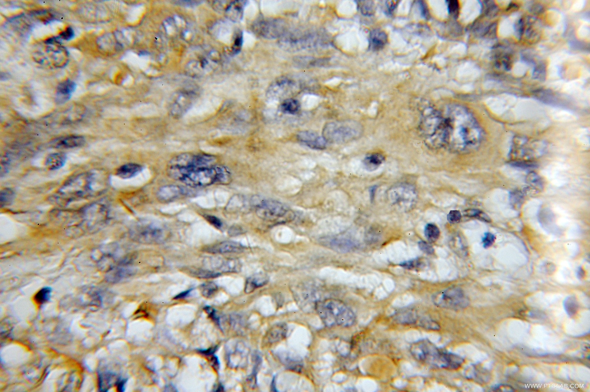 IHC staining of human gliomas using 11454-1-AP