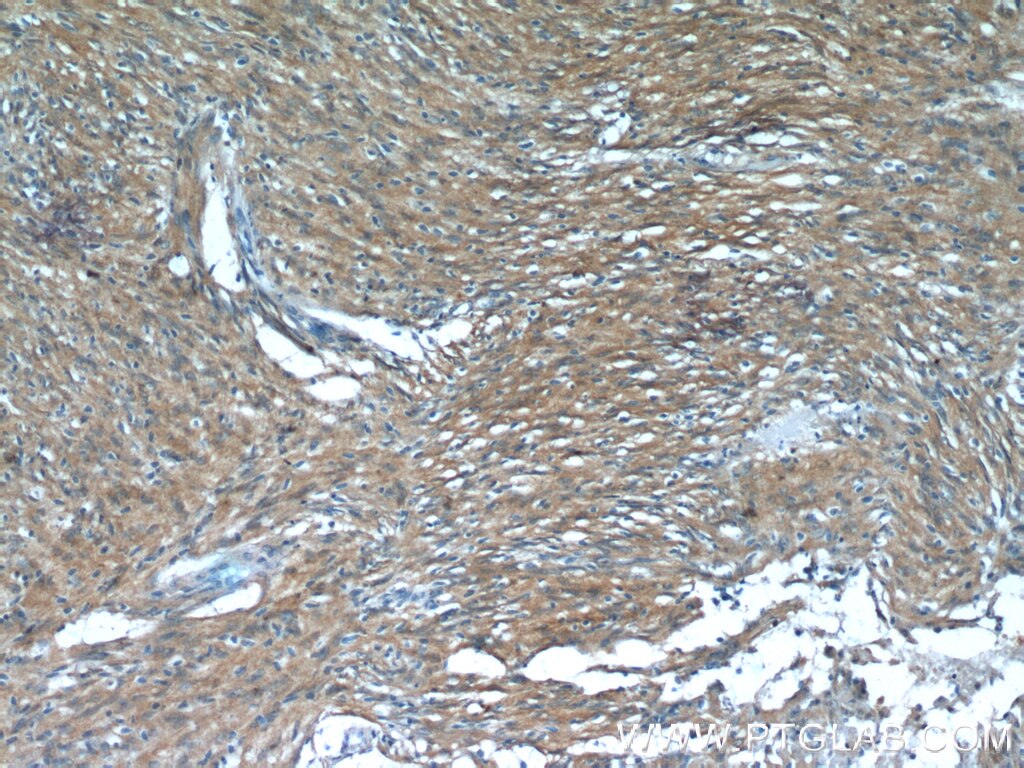 IHC staining of human meningioma using 14711-1-AP