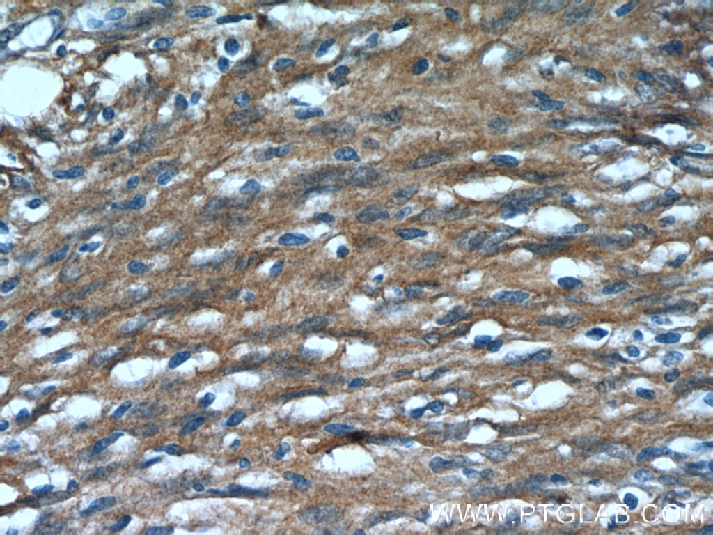 IHC staining of human meningioma using 14711-1-AP