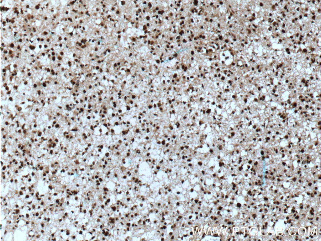 Immunohistochemistry (IHC) staining of human gliomas tissue using MGEA5 Monoclonal antibody (66033-1-Ig)