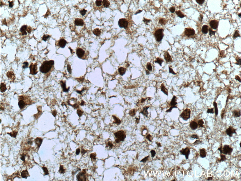Immunohistochemistry (IHC) staining of human gliomas tissue using MGEA5 Monoclonal antibody (66033-1-Ig)