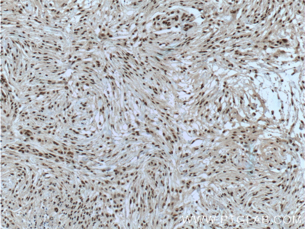 Immunohistochemistry (IHC) staining of human meningioma tissue using MGEA5 Monoclonal antibody (66033-1-Ig)