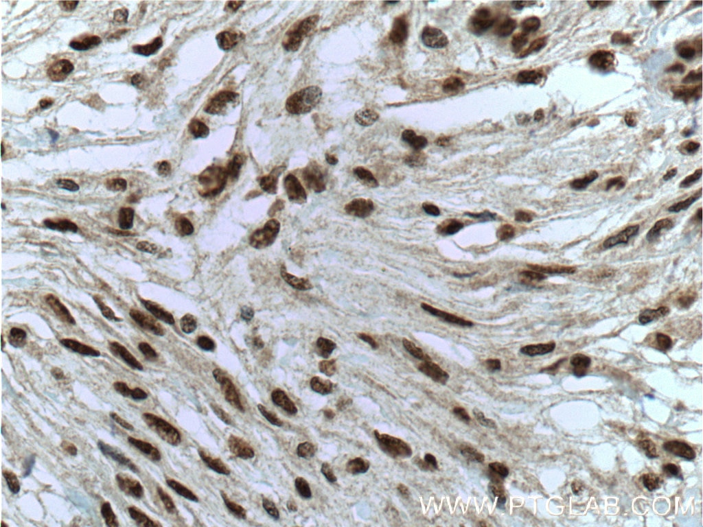 Immunohistochemistry (IHC) staining of human meningioma tissue using MGEA5 Monoclonal antibody (66033-1-Ig)