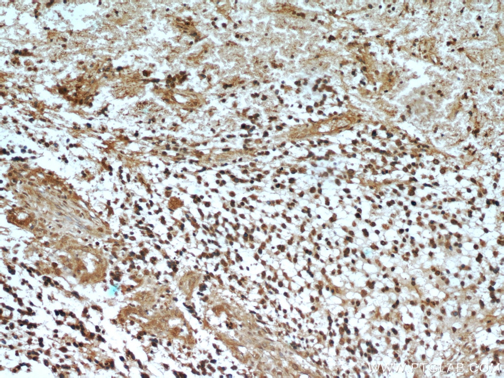 Immunohistochemistry (IHC) staining of human gliomas tissue using MGEA5 Monoclonal antibody (66033-1-Ig)