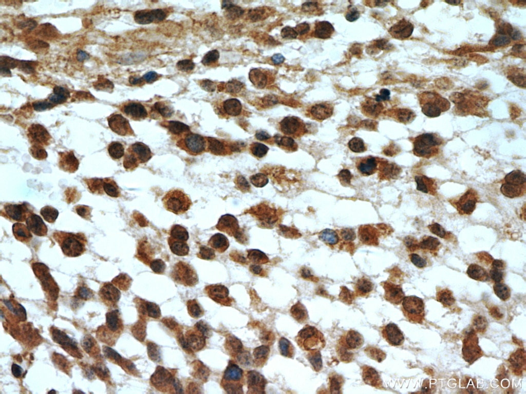 Immunohistochemistry (IHC) staining of human gliomas tissue using MGEA5 Monoclonal antibody (66033-1-Ig)